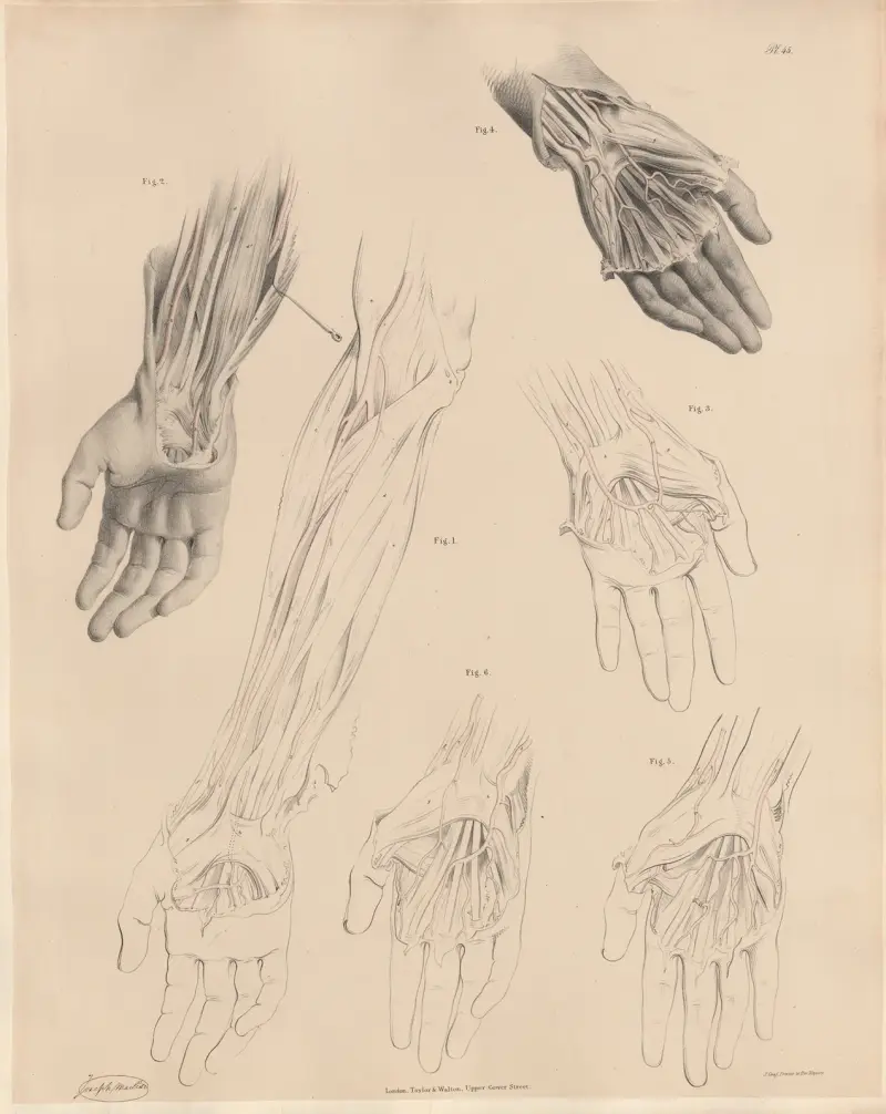 En sällsynt form av medianartär, en egendomlig muskel förbunden med ulnarartären av Joseph Maclise