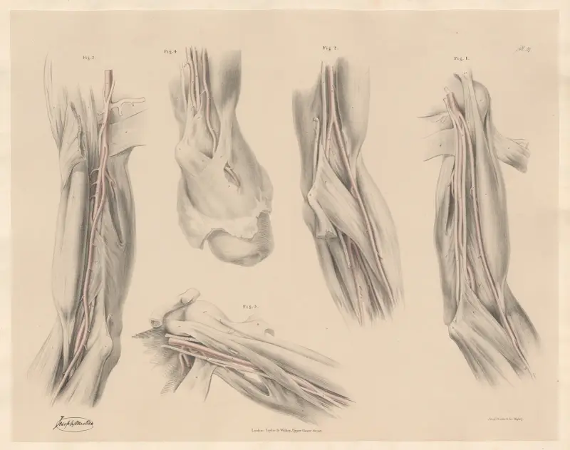 Deviations of one of the two arteries representing the brachial av Joseph Maclise