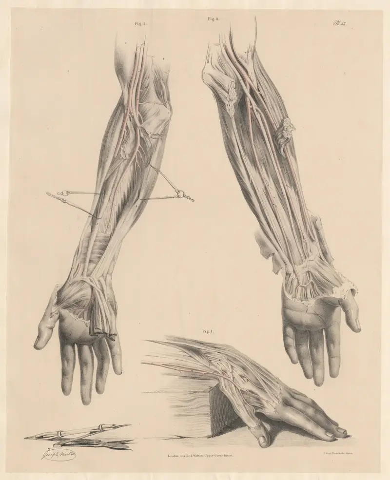Underliga former av radial-, ulnar- och interosseusartärerna i underarm och hand av Joseph Maclise