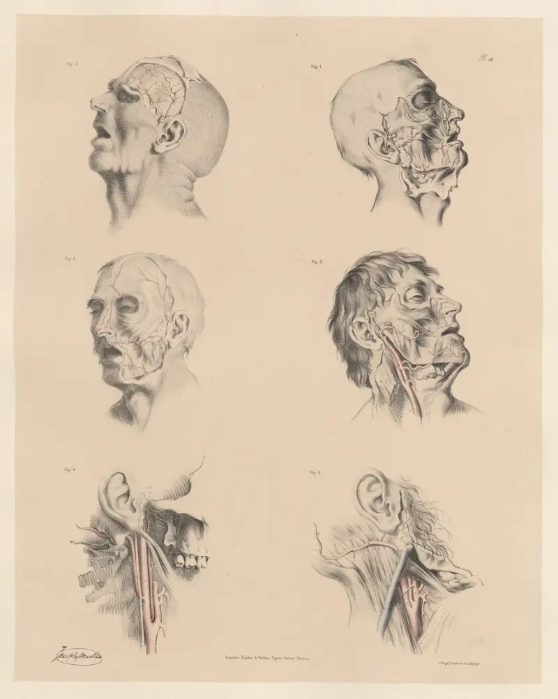 Egenheter hos de yttre halspulsådrornas grenar av Joseph Maclise