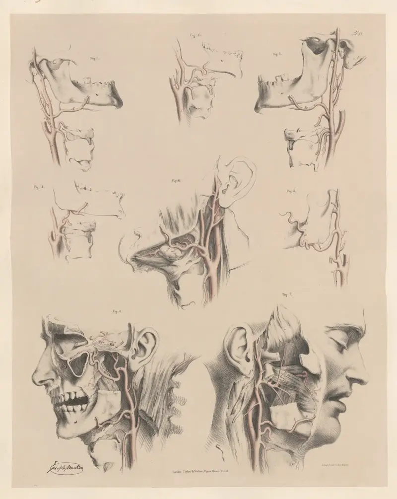 Egenheter hos de yttre halspulsådrornas grenar av Joseph Maclise