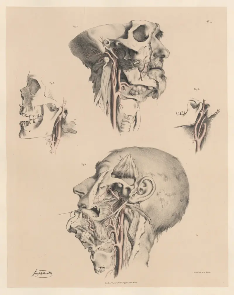 Egenheter hos de yttre halspulsådrornas grenar av Joseph Maclise