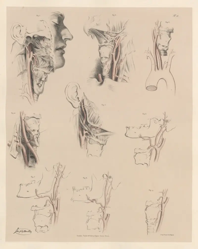 Osobliwości tętnicy szyjnej wspólnej i tętnicy szyjnej zewnętrznej, Joseph Maclise