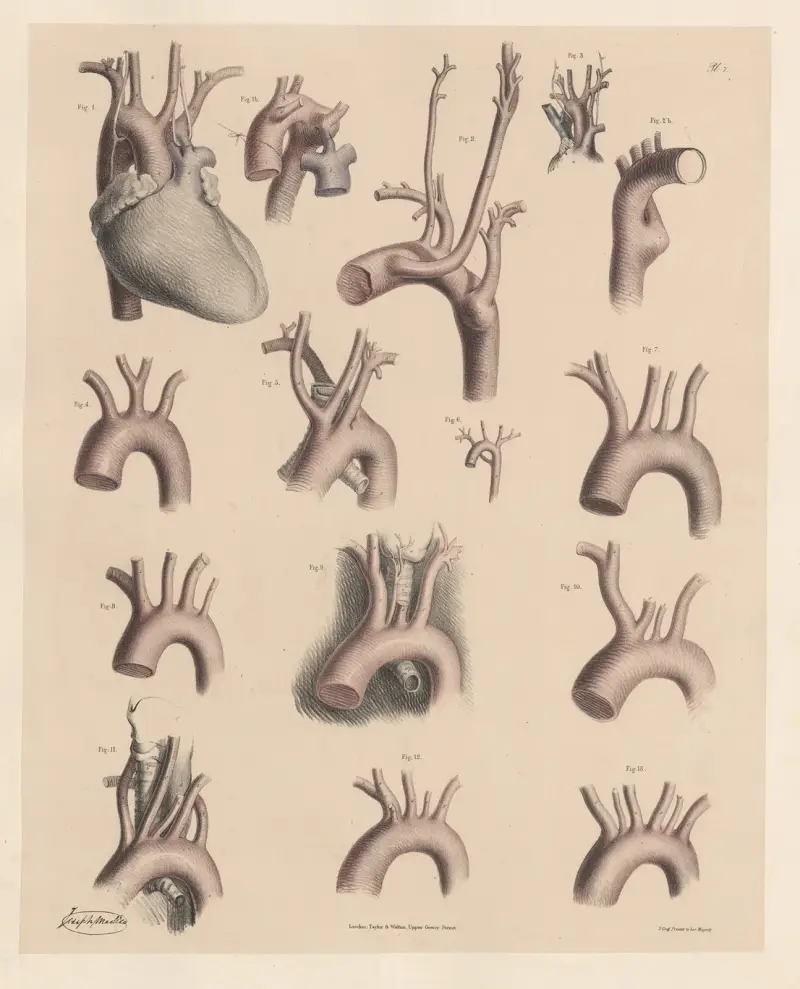 Egenheter hos de stora grenarna med ursprung från aortabågen av Joseph Maclise