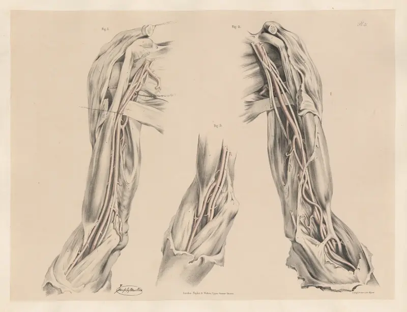 Besonderheiten der Arteria radialis – beeinflusst die Lage ihres Ursprungs von Joseph Maclise