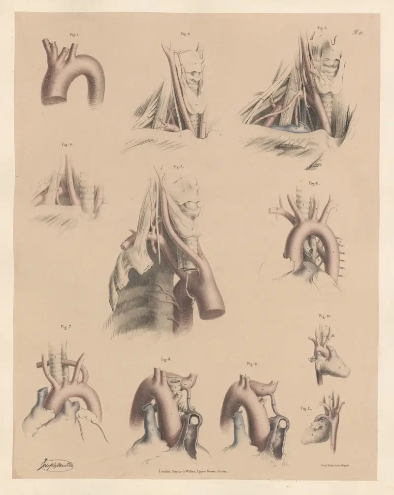 Peculiarities of the Subclavian arteries—affecting the trunk av Joseph Maclise