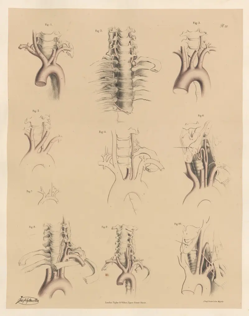 Peculiarities of the Vertebral arteries av Joseph Maclise