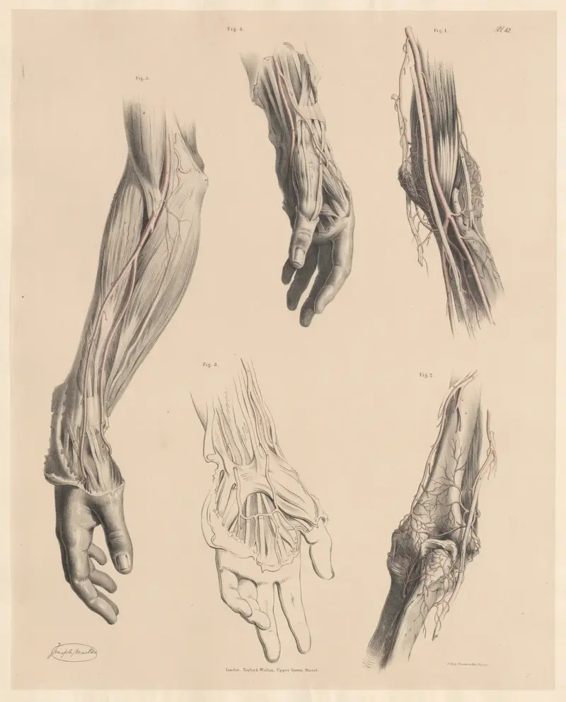 De artäriella grenarna som anastomoserar kring armbågsleden, egenheter hos radialartären av Joseph Maclise