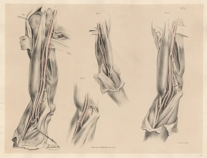 Die Achsel- oder Armarterien, in zwei Äste geteilt von Joseph Maclise