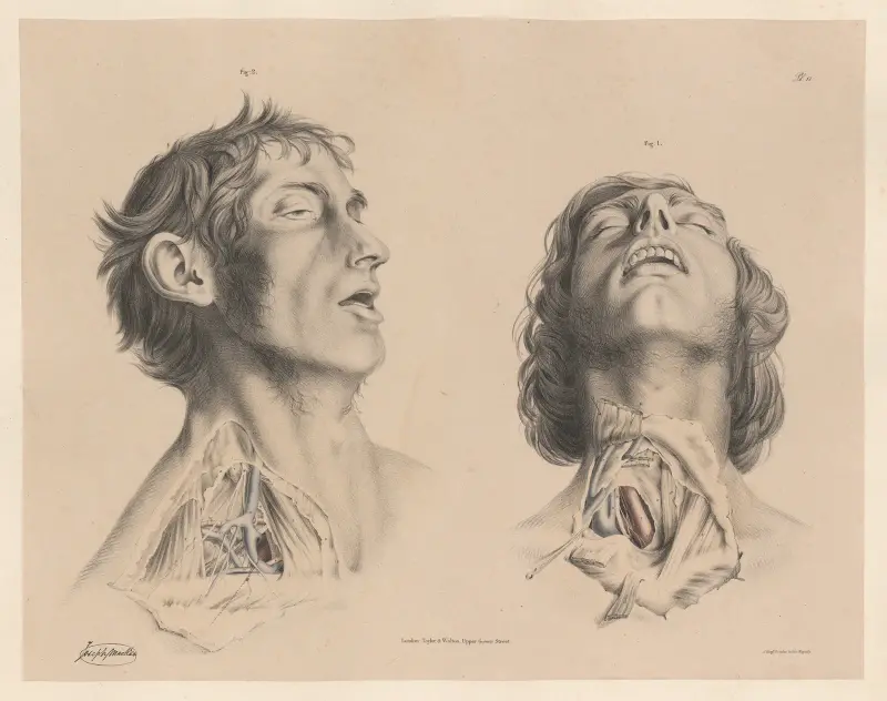 Začátek pravé podklíčkové tepny, Konec pravé podklíčkové tepny, Joseph Maclise