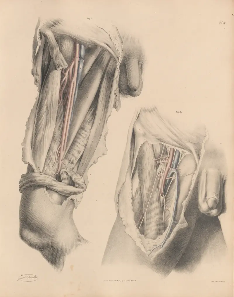 The Femoral artery, with nerves and veins, Double Femoral artery av Joseph Maclise