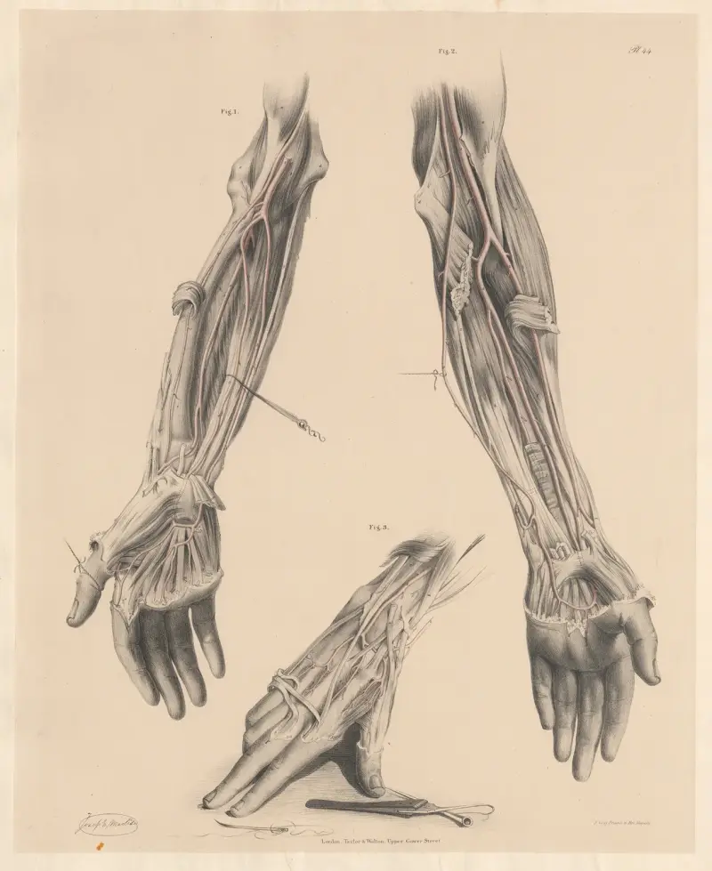 The Interosseous joins in different cases with the other two arteries of the fore-arm av Joseph Maclise