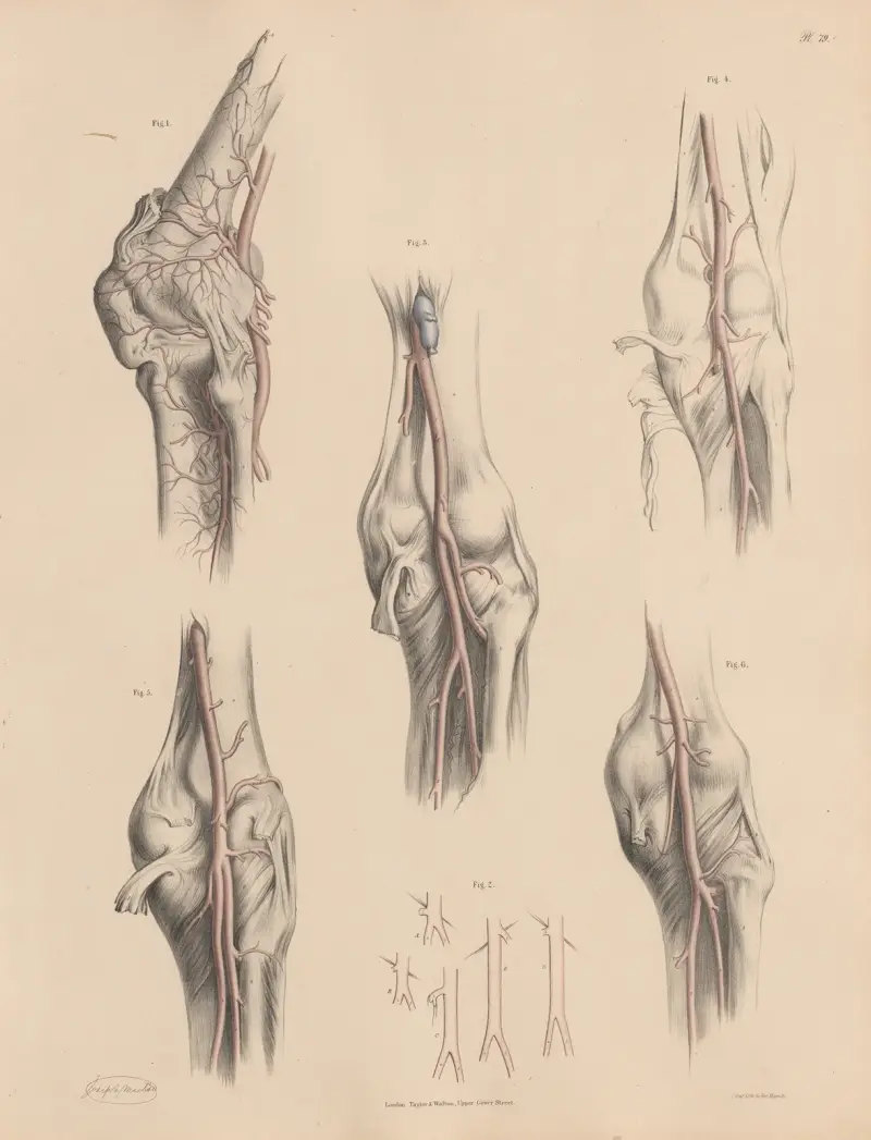 Poplitealartären och dess egenheter av Joseph Maclise