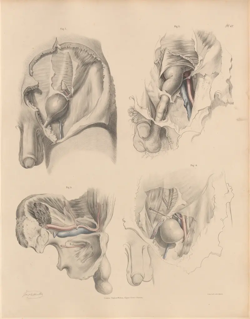 The position of the Epigastric artery with reference to different kinds of hernia av Joseph Maclise