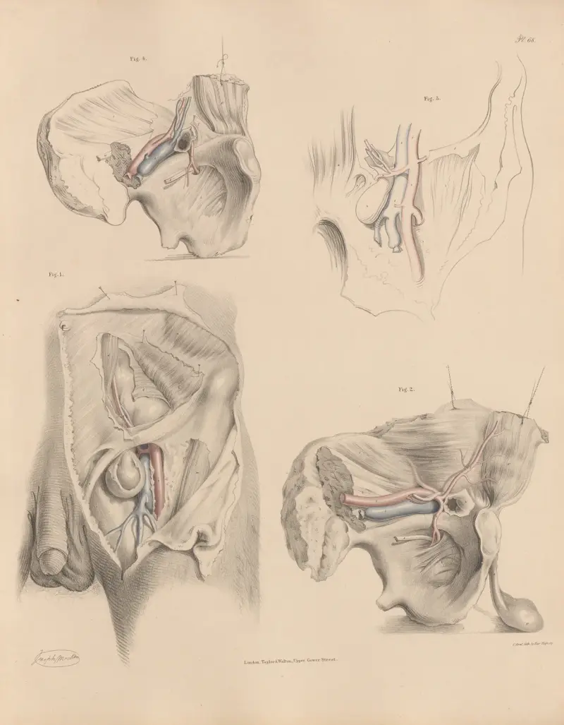 The various relations of the Obturator artery to different kinds of hernia av Joseph Maclise