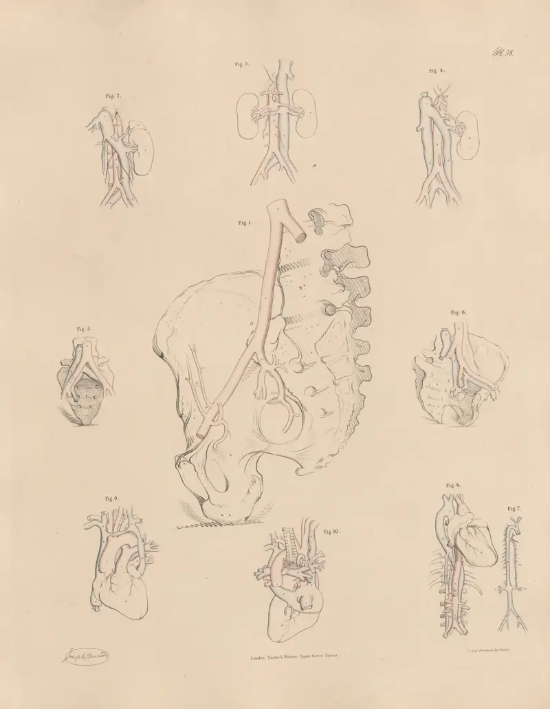Unusual conformation of the Iliac arteries av Joseph Maclise
