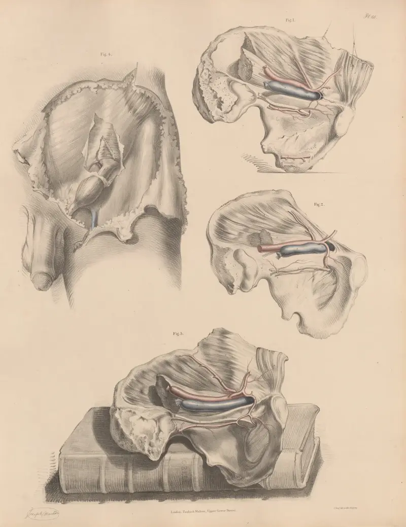Olika tillstånd hos obturatorartären och epigastriska artären i samband med bråck av Joseph Maclise