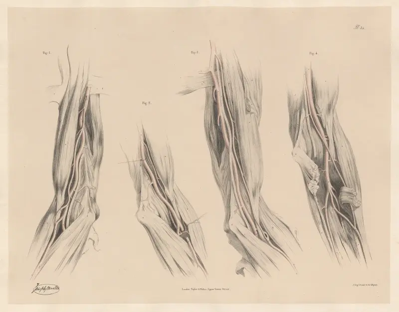 Verschiedene Beispiele von ‚Vasa Aberrantia‘, aus der Achselhöhle austretend von Joseph Maclise