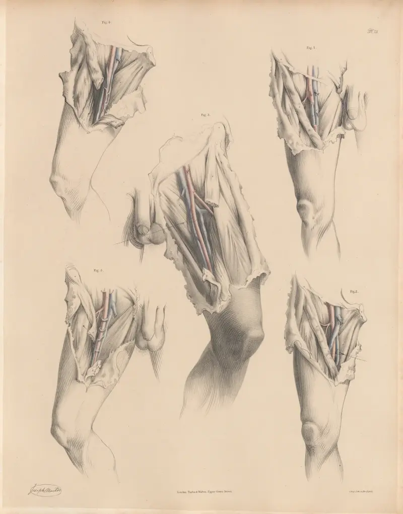 Various forms of the Veins connected with the Femoral artery av Joseph Maclise